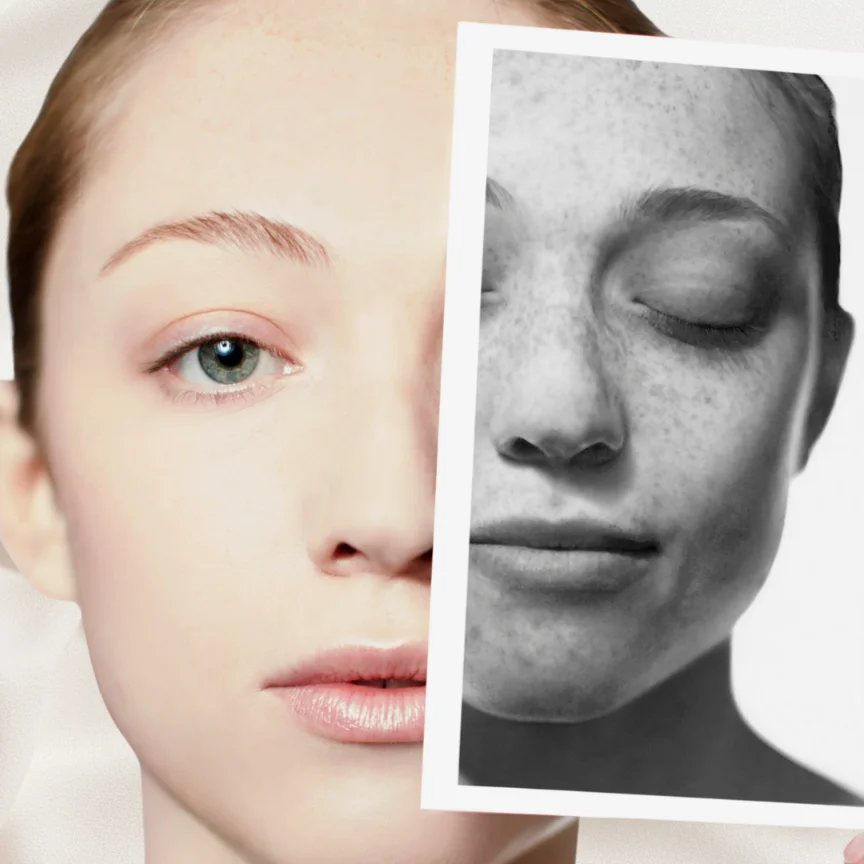 Freckle Cover in Kolkata