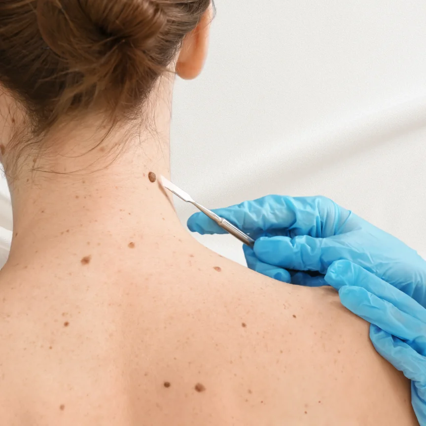 Mole Removal in Kolkata