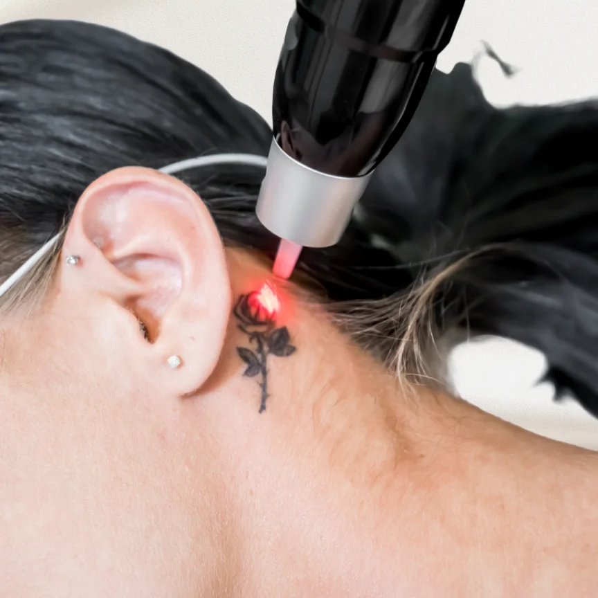 Laser Tattoo Removal in Kolkata