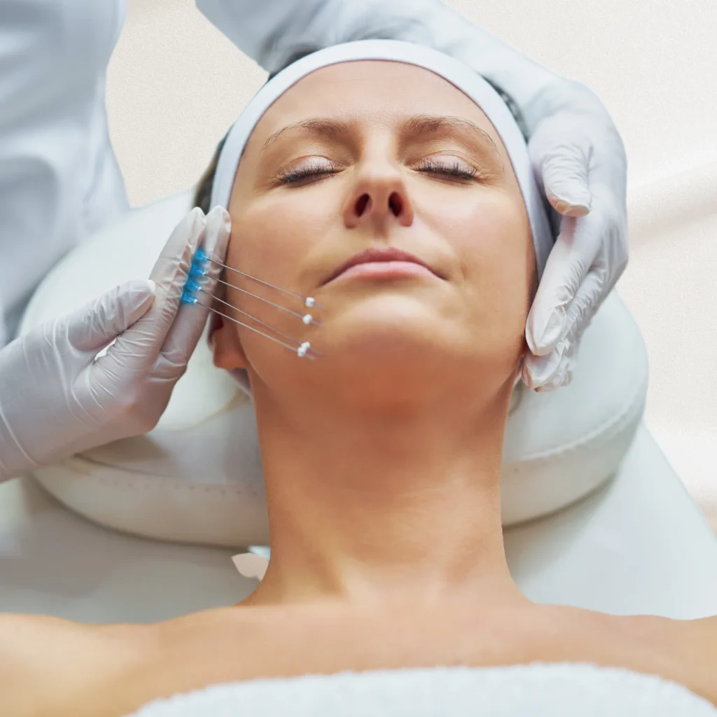 Thread Lift Treatment in Kolkata